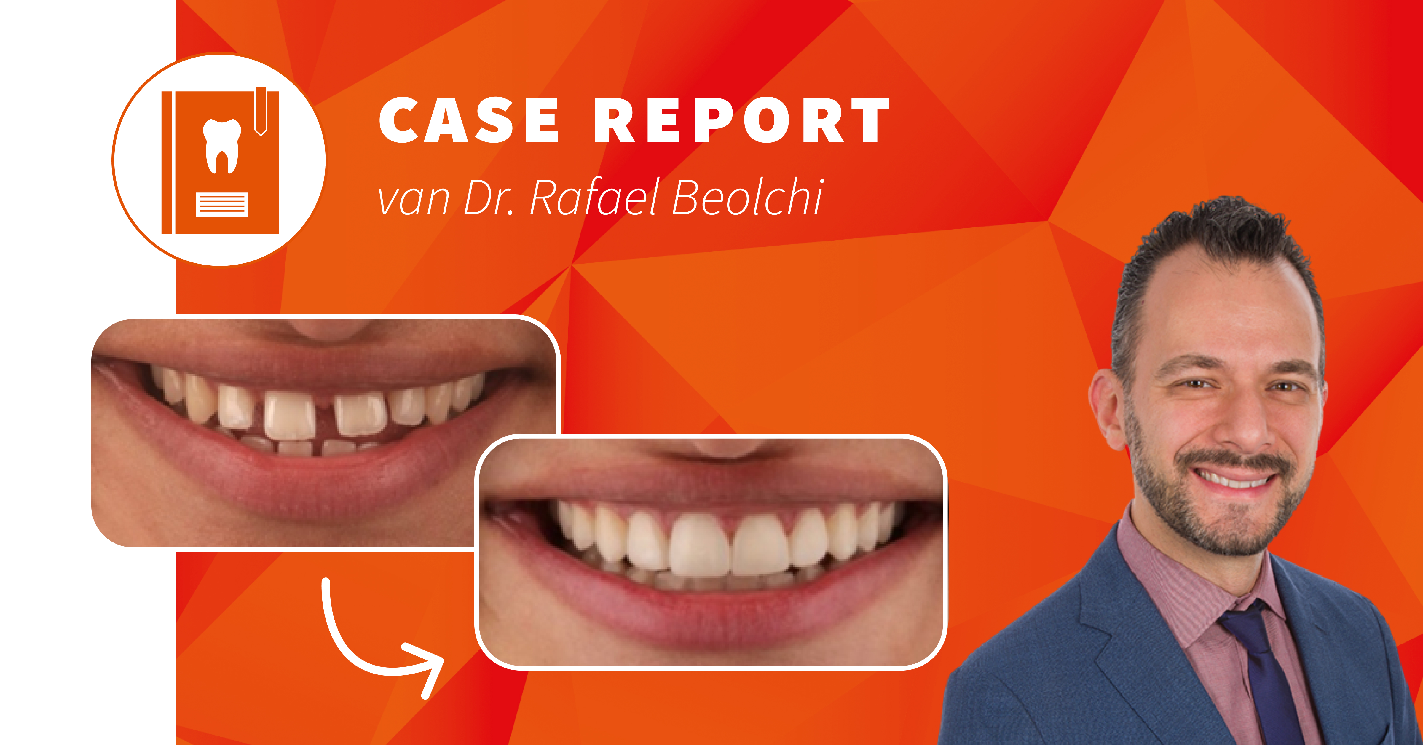 Hoe diodelasers en universele composieten het dagelijkse praktijkleven vereenvoudigen