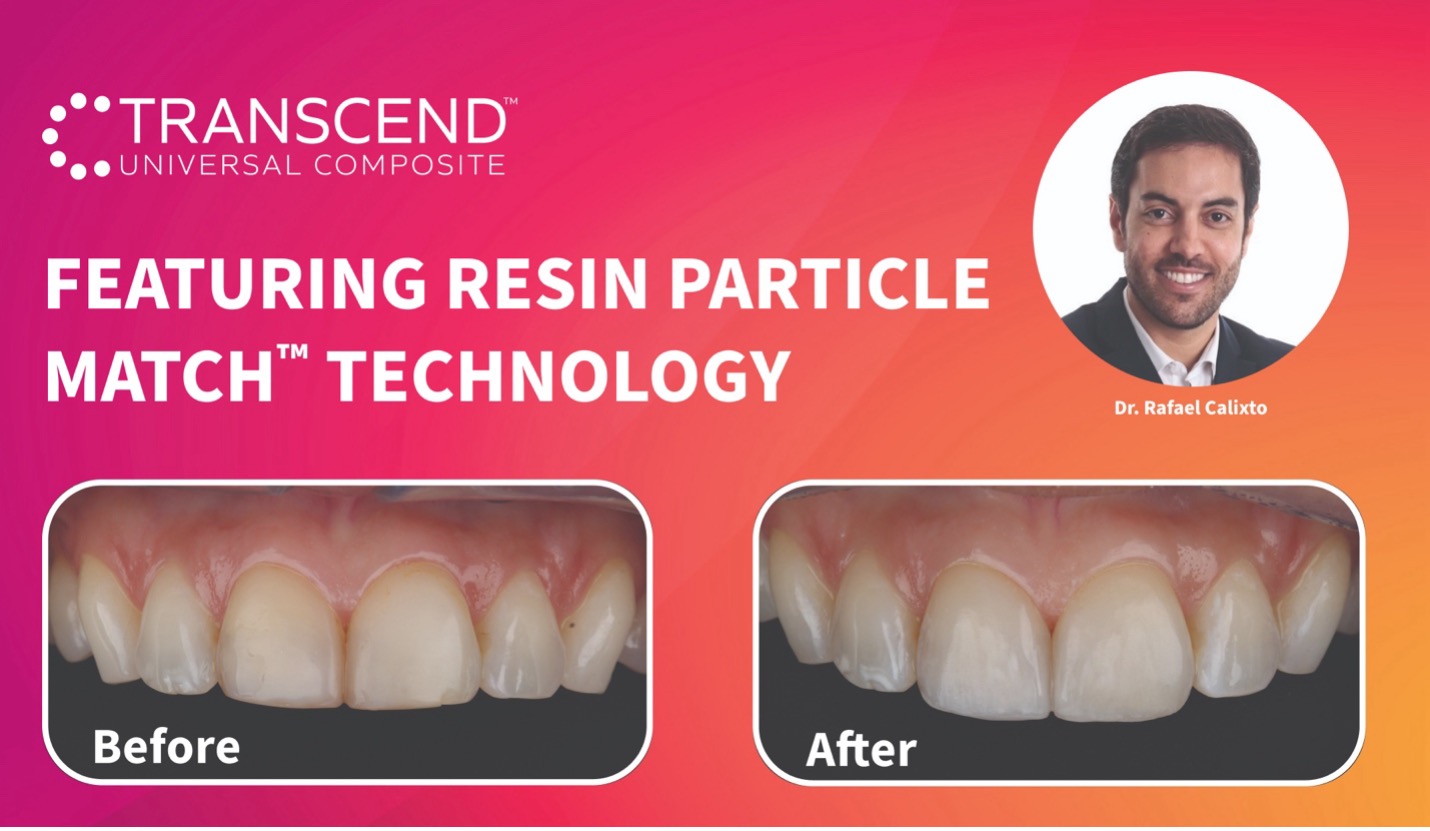 Klinische handleiding: Klasse II-restauratie van de centrale bovenincisieven