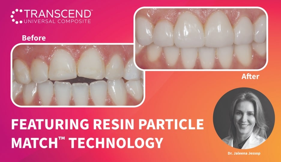 Klinische handleiding: Composietveneers zonder preparatie, gebitselement 13-23